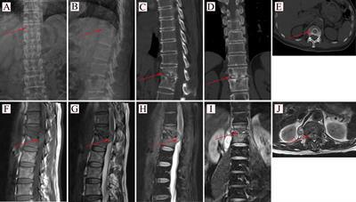 Mechanism of COVID-19-Related Proteins in Spinal Tuberculosis: Immune Dysregulation